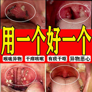 扁桃体发炎肥大肿大喉咙肿痛有痰异物感药爽嗓子咳嗽咽喉干痒喷剂