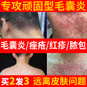 汗斑露喷剂