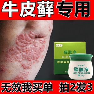牛皮藓专用药膏