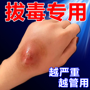 拔毒膏吸脓头火疖子神器屁股上长痘痘坐疮膏拔脓拔毒止痒专用药贴
