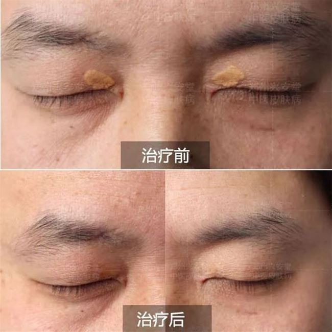 睑黄瘤膏