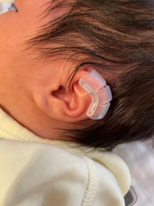 婴儿矫正器贴面耳贴面耳撑招风耳神器精灵耳新生的儿耳朵矫正器