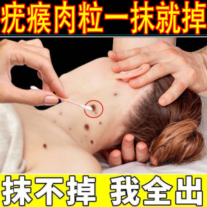 刺猴去除正品治瘊子去猴子肉粒疙瘩祛鱼鳞痣手足部脚肉刺专用药膏