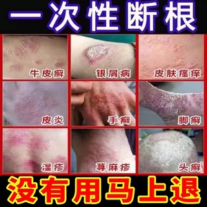 治疗牛皮廯藓银屑病止痒抑菌皮肤瘙痒湿疹去根股体癣专用祛癣药膏