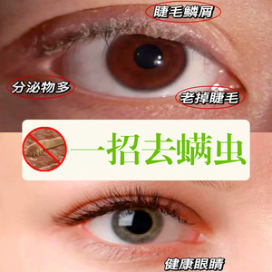 眼部干痒症除螨湿巾茶树油4松油醇眼睑清洁眼睛螨虫 茶树精油眼贴