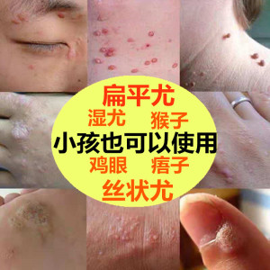 丝状疣克舒软膏肉刺瘊子寻跖疣特效去除尤净灵病毒疣必治