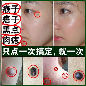 点痣膏无痕正品去痣药水脸部中药去黑点祛痣神器除痣灵防疤取痦子