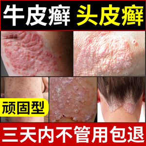 银屑癣头皮癣铜钱癣药膏正品杀菌真菌克星皮肤瘙痒外用药湿疹止痒
