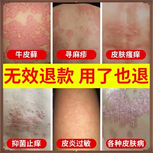 苗医丹毒皮康王药膏正品止痒湿疹皮炎膏灰黄霉素药复方咪康唑软膏