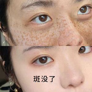 跟斑点说拜拜】去脸部各种顽固斑迹 淡化脸上黑色素 男女可用