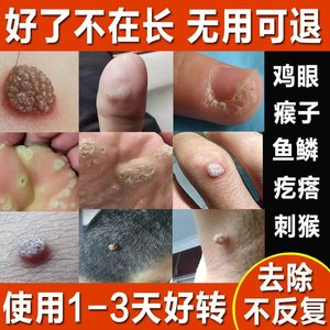 祛瘊子药鱼鳞痣贴休子药去猴子肉粒疙瘩治脚肉刺猴去除膏神器正品