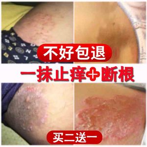 阴囊瘙痒潮湿大腿内侧私处肛门男士jj女外阴私处痒疙瘩皮肤止痒膏