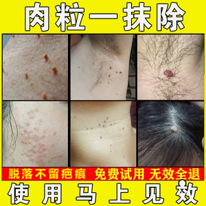 同款货源清水浮萍好品正品店淘宝扁平疣非藥膏日本点去除去小肉粒