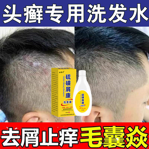 头癣专用洗发水银屑癣治顽固性皮癣皮痒药膏头痒有疙瘩毛囊炎头部