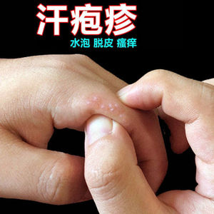 手上脚上起小水泡瘙痒治汗状孢疹止痒专用药膏成人儿童九都誉健坊