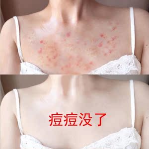 前胸后背祛痘喷雾背部神器去背后痘痘胸口背上长痘粉刺痘印清除螨