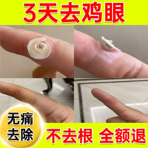 鸡眼膏鸡眼贴脚钉去除脚上脚底手上肉刺鸡贴眼脚水杨酸鸡眼药