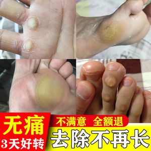 906人付款淘宝茧立清去除脚茧脚底老茧手茧茧子脚垫膏专用死皮软化剂