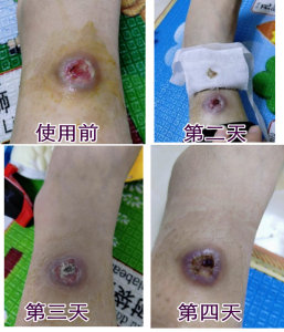 褥疮老人外伤消  炎促进长肉伤口结痂快速愈合老烂腿生肌散止血粉
