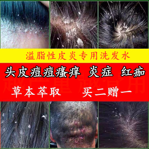 治毛囊洗炎的发水头发痒头皮红疙瘩头上长痘痘头发 去屑止痒医药