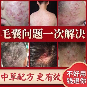 治疗头皮毛囊炎专用头部脖子前胸后背私处马拉色菌痘痘中药酊膏药