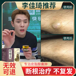 00华屹堂淘宝皮脂腺囊肿膏粉瘤痘痘贴拔毒火疖子巴氏腺前庭皮下腘窝