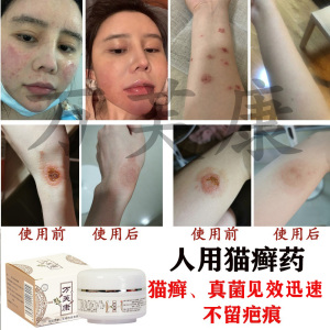 猫藓人用药治疗人患猫癣药真菌感染得狗癣皮肤病外用圆癣药膏人用