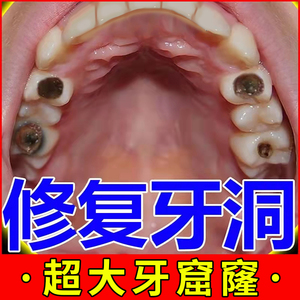 补牙齿洞膏蛀牙修复牙洞自己补补牙缝的胶神器堵牙洞树脂材料工具