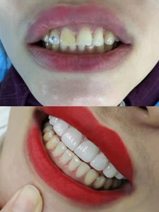 义获嘉全瓷贴面牙齿贴片修复美白进口全瓷牙齿陶瓷贴面烤瓷牙神器