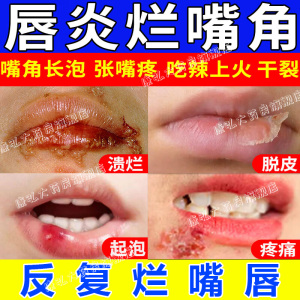 1%*20g*1支/盒 _ 唇炎专用药膏唇炎唇膏嘴唇干裂脱皮修护唇炎烂嘴角