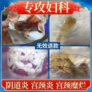 妇科凝胶私处护理抑菌宫颈烂糜用药霉菌性豆腐渣女阴道私密保养炎