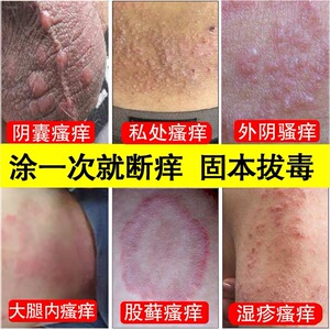 狸俚米男康喷剂龟头炎型私处潮湿异味瘙痒健龟草本宁乳膏乐康正品