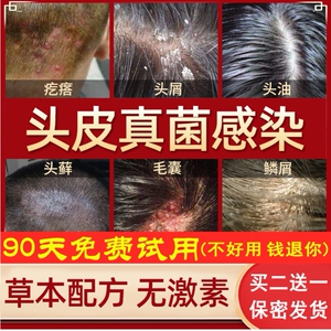 ♂潇洒哥♂淘宝脸上长癣 脸部治头癣的药膏治疗头皮藓治牛皮癣头皮