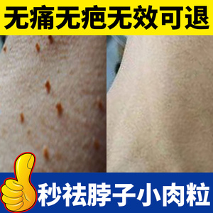 祛瘊子肉瘤去除膏去猴子脖子上长小肉粒疙瘩皮赘药点痦子肉痣神器