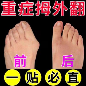 拇指外翻贴矫正贴拇囊炎内扣大脚骨专用贴矫正器女拉力带腱鞘炎