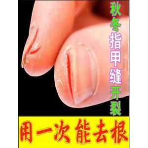 手指裂口子指甲缝勒口脚趾皲裂膏秋冬季皲裂开裂手指干燥粗糙裂口