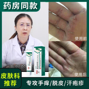 手脱皮药膏真菌感染治疗的药膏手藓烂上起小水泡手痒脱皮汗疱疹用