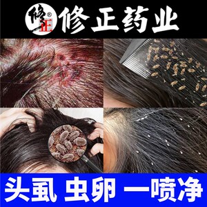 头上长虱子儿童