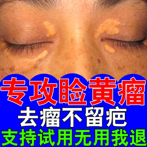 去除睑黄疣睑黄瘤黄斑去除药膏眼部去脂肪粒汗管瘤眼部黄斑专用药