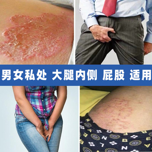 804人付款淘宝外阴瘙痒止痒膏私处女性男性下身阴毛痒阴道口霉菌骚痒