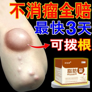 脂肪留去除神器消瘤贴消除硬块粉留皮下脂肪颗粒皮脂腺囔肿消瘤膏