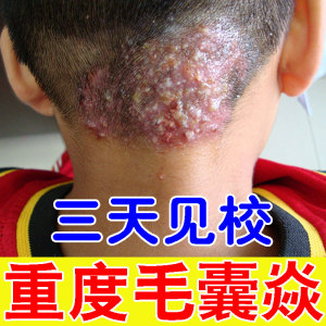 头皮毛囊炎神器