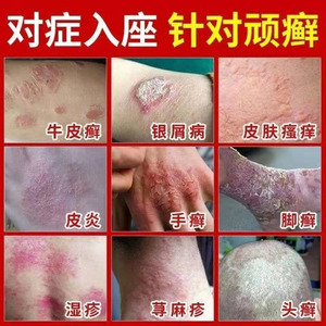love超越淘宝梵赞克洛芬软膏 克洛芬草本抑菌乳膏 梵赞克洛分软膏