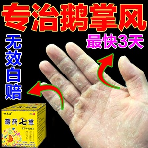 鹅掌风药膏手脱皮药膏真菌感染蜕皮干裂水泡手痒手藓膏手气膏烂手