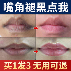去嘴唇边黑唇周围褪黑色素沉淀去除脸部嘴角暗沉发黑淡化唇部