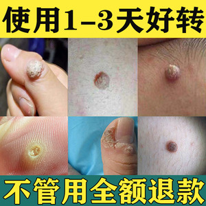 去猴子的药肉粒疙瘩治瘊子的药休子鱼鳞痣肉刺猴去除神器手部正品