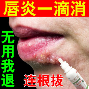 上火起泡膏嘴唇