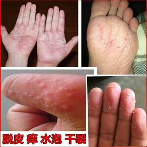 水泡手掌治疗真菌感染苗家药膏专治鹅掌风药膏手癣手脚脱皮药膏鲜