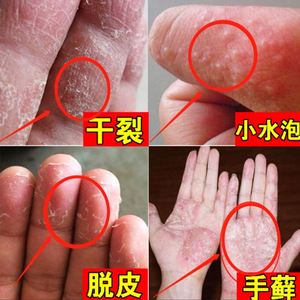 治疗治疗手上水泡手指真菌感染脚后跟手脱皮真菌感染手指脱皮药膏