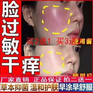 脸上过敏皮肤痒药膏修复激素脸干燥起皮面部红疹止脂溢性皮炎专用